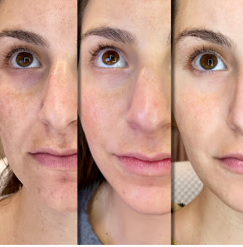 Collagen Bar NYC Microneedling and Body Contouring