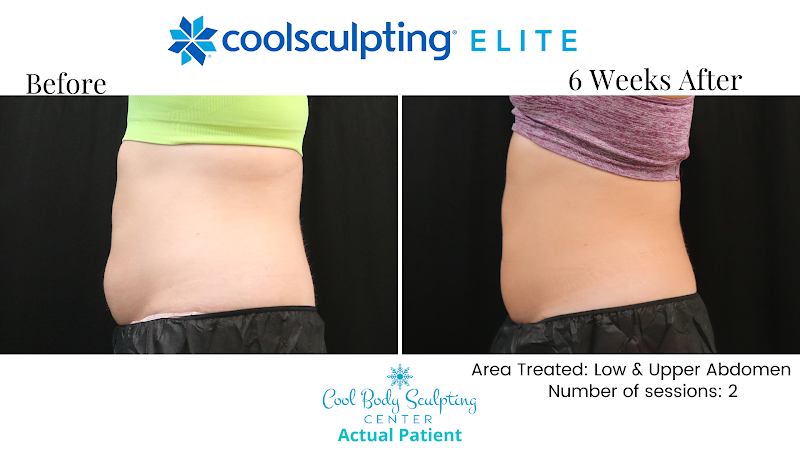 Cool Body Sculpting Center